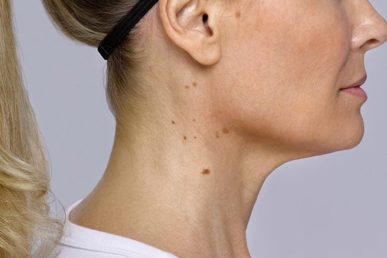 If You Have Bumps On Your Neck Here S What It Could Mean Reader S Digest