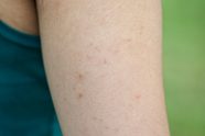 Keratosis Pilaris How To Get Rid Of Chicken Skin Reader s Digest