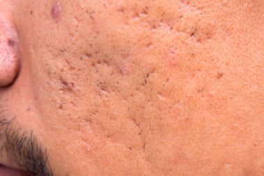 How to Get Rid of 5 Common Types of Acne Scars | Reader's ...