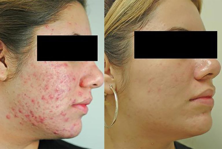 Before and After Photos of Skin and Acne Treatments  Reader's Digest