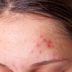 What the Acne on Every Part of Your Body Is Trying to Tell You