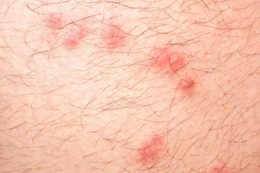 How to Identify These 9 Common Bug Bites | Reader's Digest