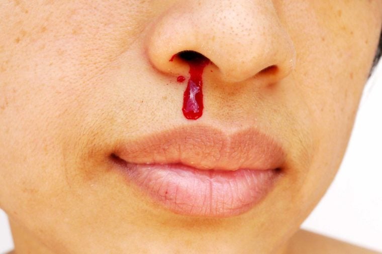 what-causes-nosebleeds-surprising-reasons-your-nose-is-bleeding