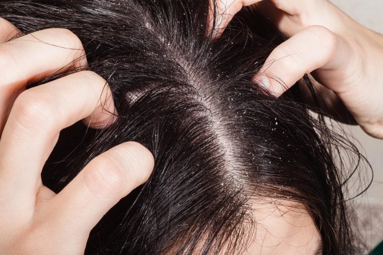 21-reasons-for-your-itchy-scalp-besides-head-lice-reader-s-digest