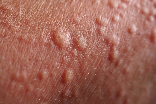 small-itchy-bumps-pictures-photos