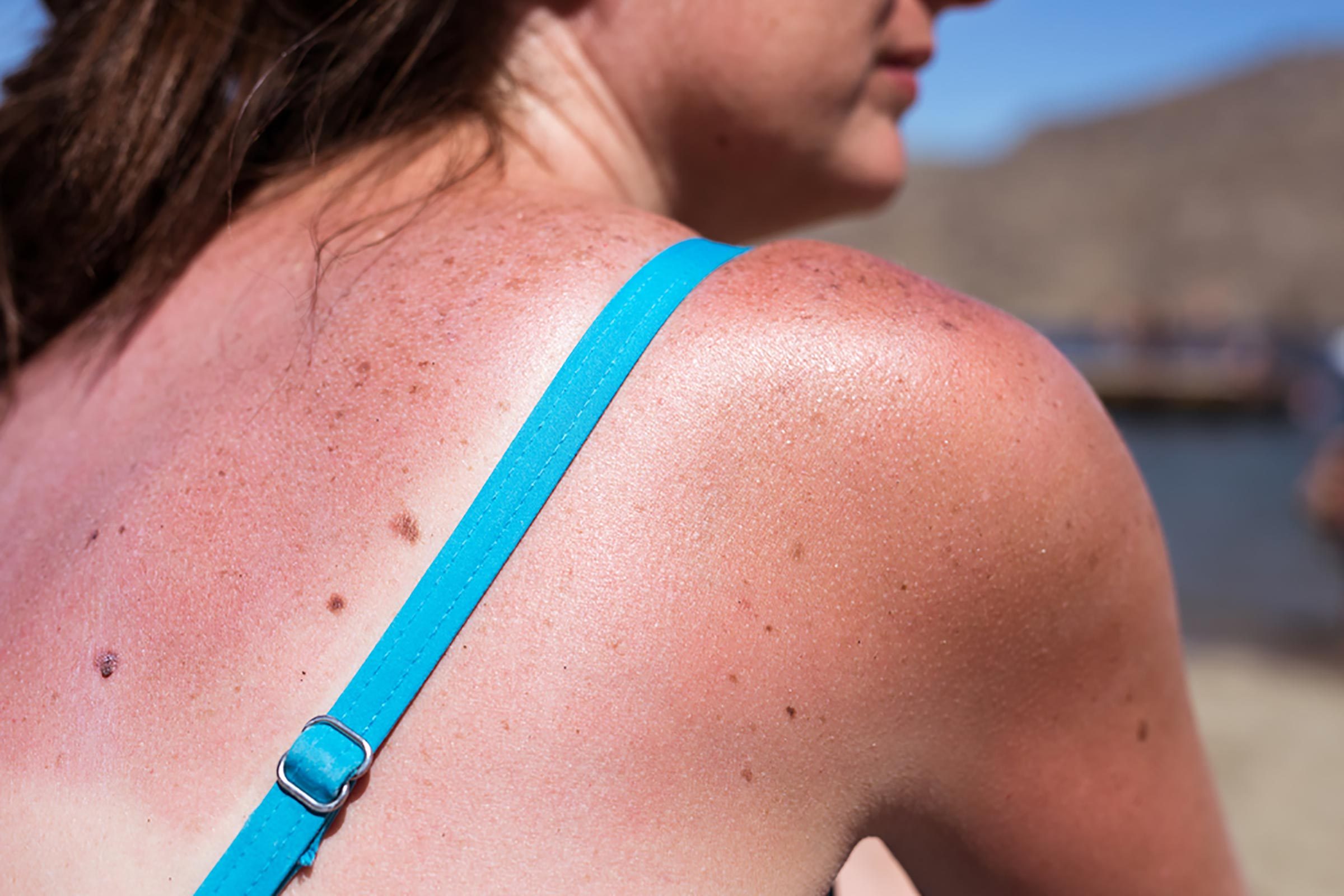 Sun Exposure Signs You Ve Gotten Too Much Sun The Healthy