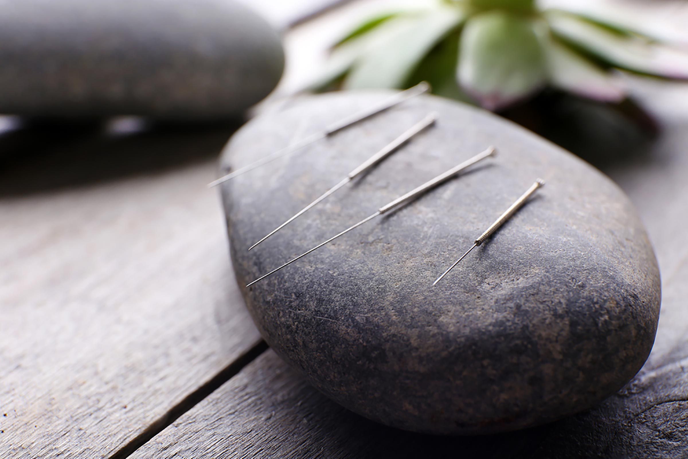 reasons-to-try-acupuncture-for-weight-loss-reader-s-digest