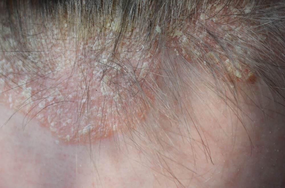 Scalp Psoriasis: What Dermatologists Wish You Knew | Reader's Digest