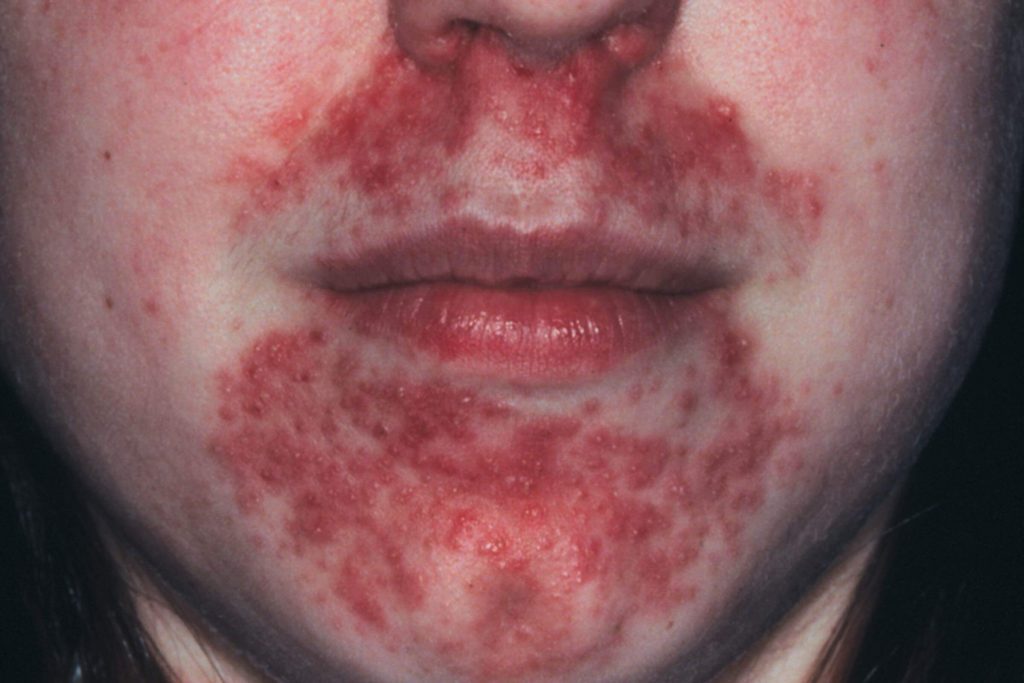 Perioral Dermatitis: How to Treat It | Reader's Digest