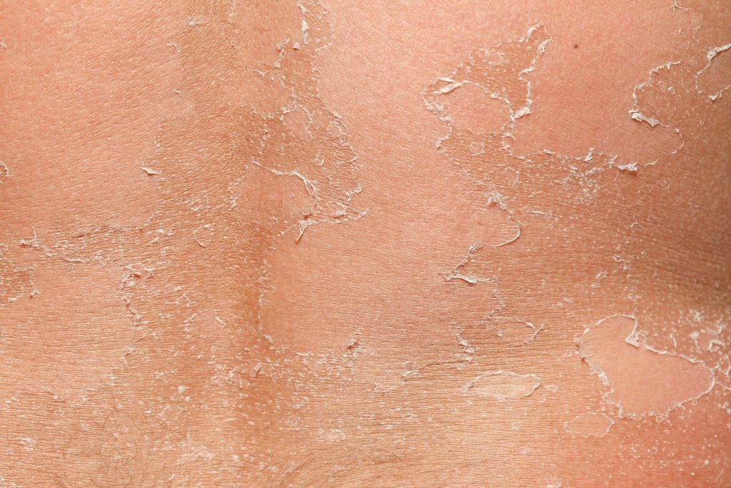 What Does It Mean When Your Skin Is Peeling Off