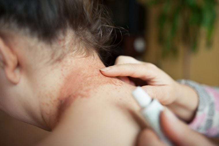 A nurse lubricating damaged eczema neck by healing ointment (color toned image)