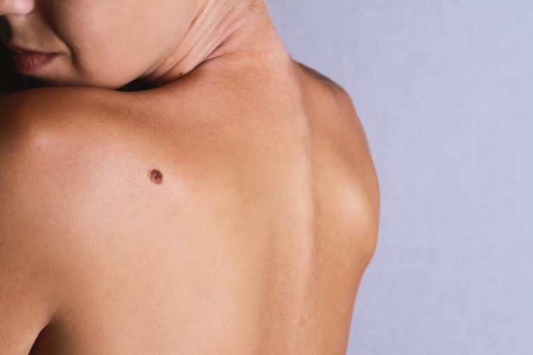 Checking benign moles : Young woman looking with birthmark on her back / skin. Sun Exposure effect on skin, Health Effects of UV Radiation