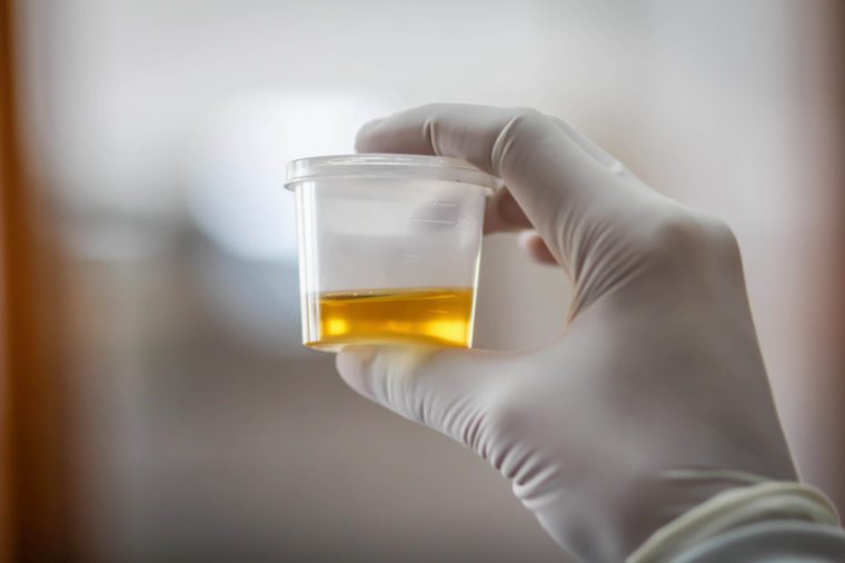 Urine sample