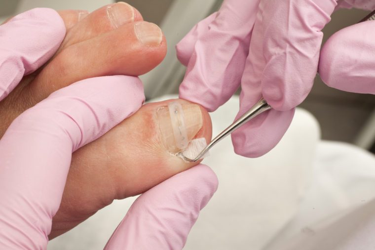 Pedicure Dangers That Could Land You in the ER