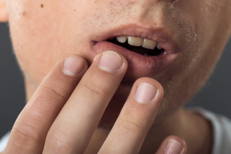 Close up portrait of man lips infected herpes virus standing on gray background virus