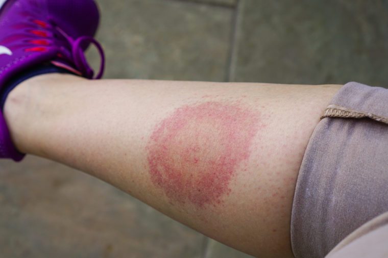 Lyme disease, Borreliosis or Borrelia, typical lyme rash, spot. A person, leg bitten by a deer tick. Selective focus.