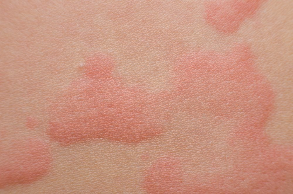 Skin Problems That Could Be a Sign of Serious Disease | The Healthy