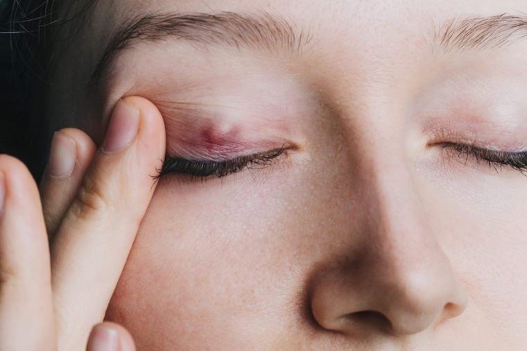 how-to-get-rid-of-a-stye-the-right-way-the-healthy