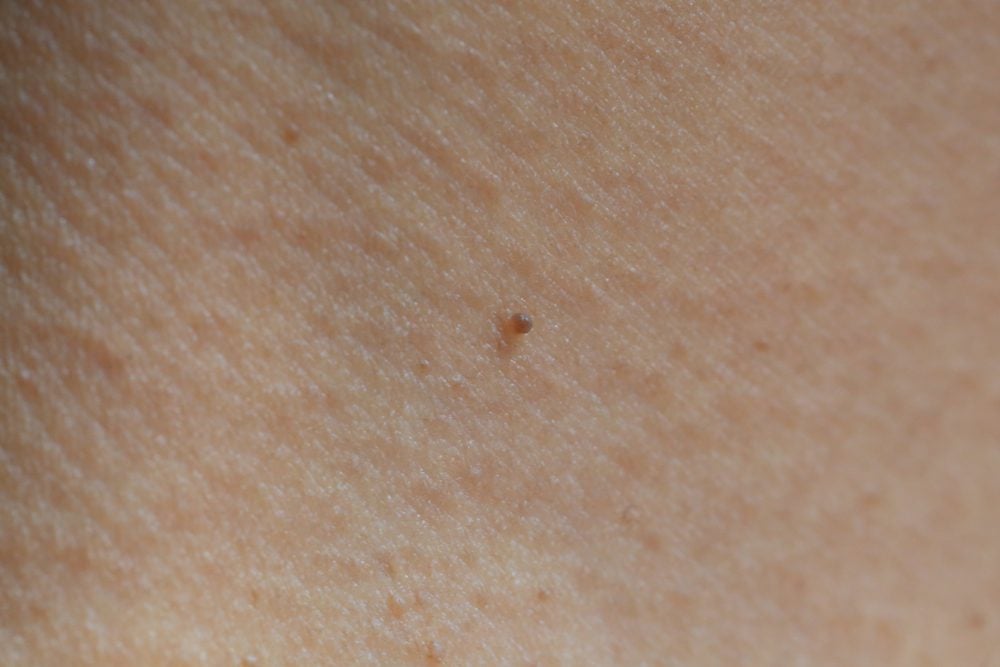 little-bumps-on-neck-skin