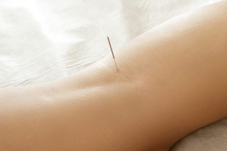  Alternative medicine. Close-up of female legs with steel needles during procedure of acupuncture therapy.