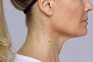 If You Have Bumps On Your Neck Here s What It Could Mean Reader s Digest