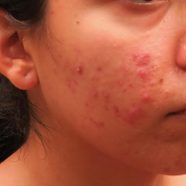 Dr Pimple Popper Reveals The Acne You Shouldn t Pop Reader s Digest