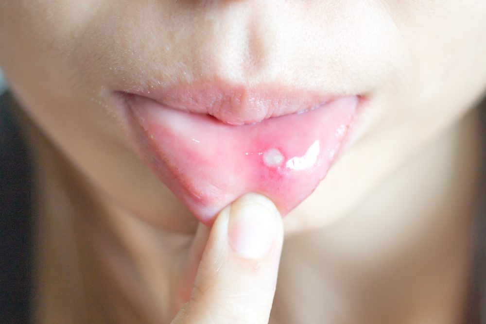 what-are-canker-sores-and-how-do-you-get-rid-of-them-self