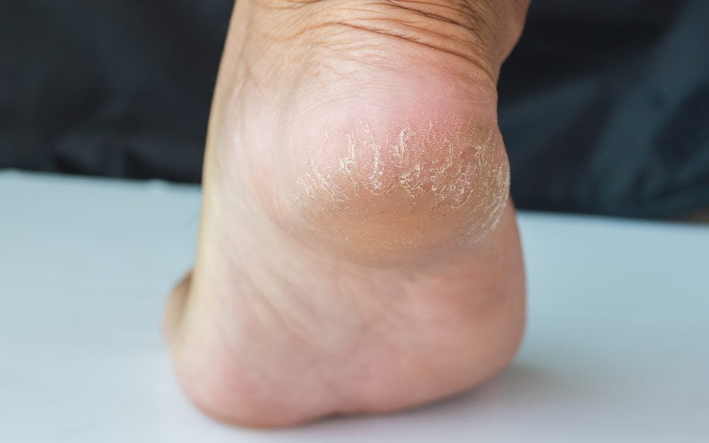 What Really Causes Cracked Heels—and 