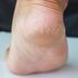 What Really Causes Cracked Heels—and How to Get Rid of Them