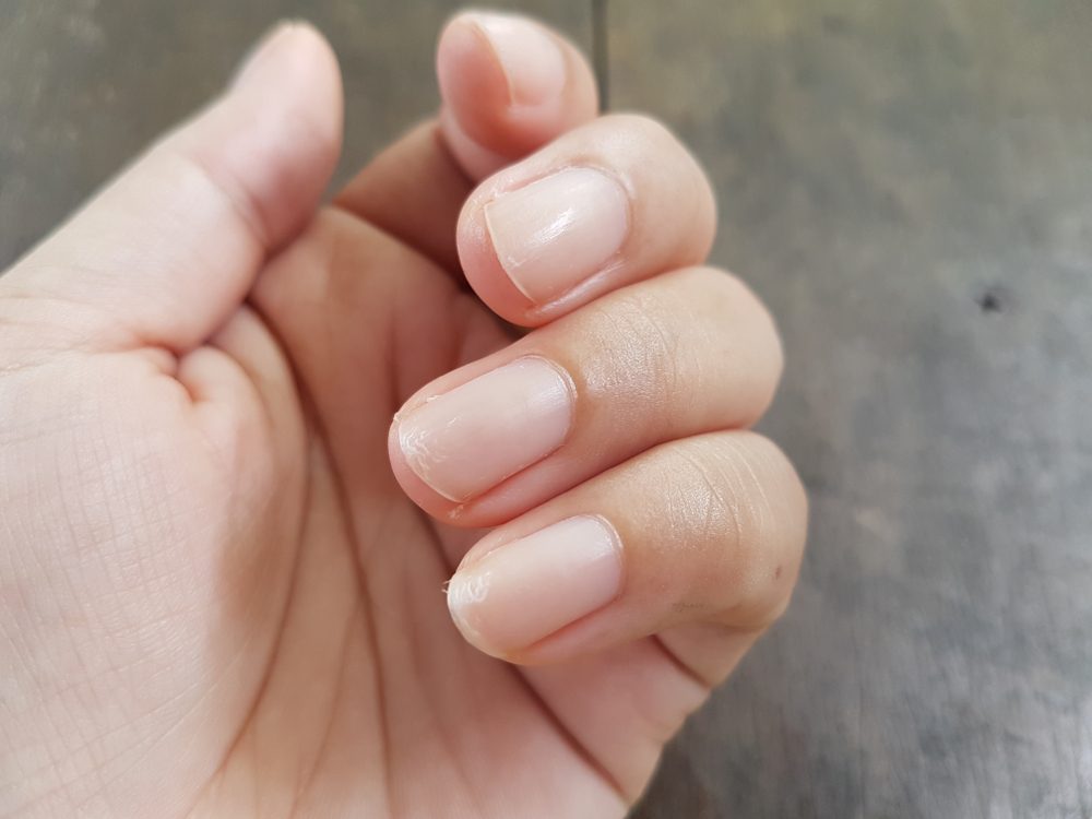 Peeling Nails: What It Could Mean | Reader's Digest
