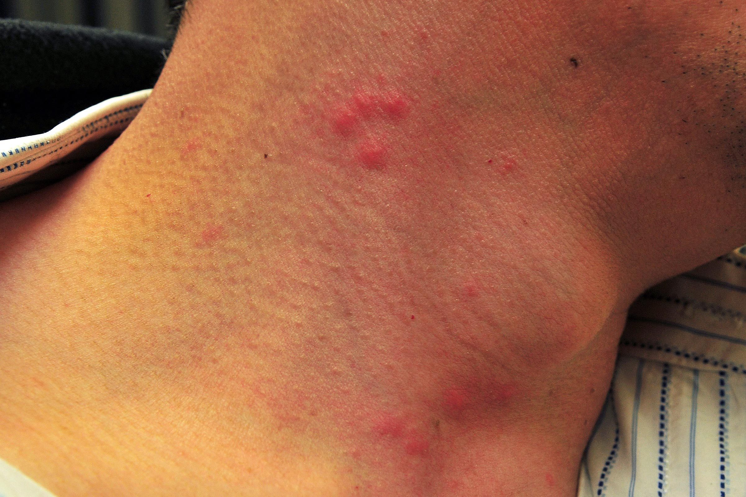 mattress mild bites day 2 bed bugs