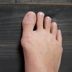 7 Ways to Treat Bunions (Without Surgery)