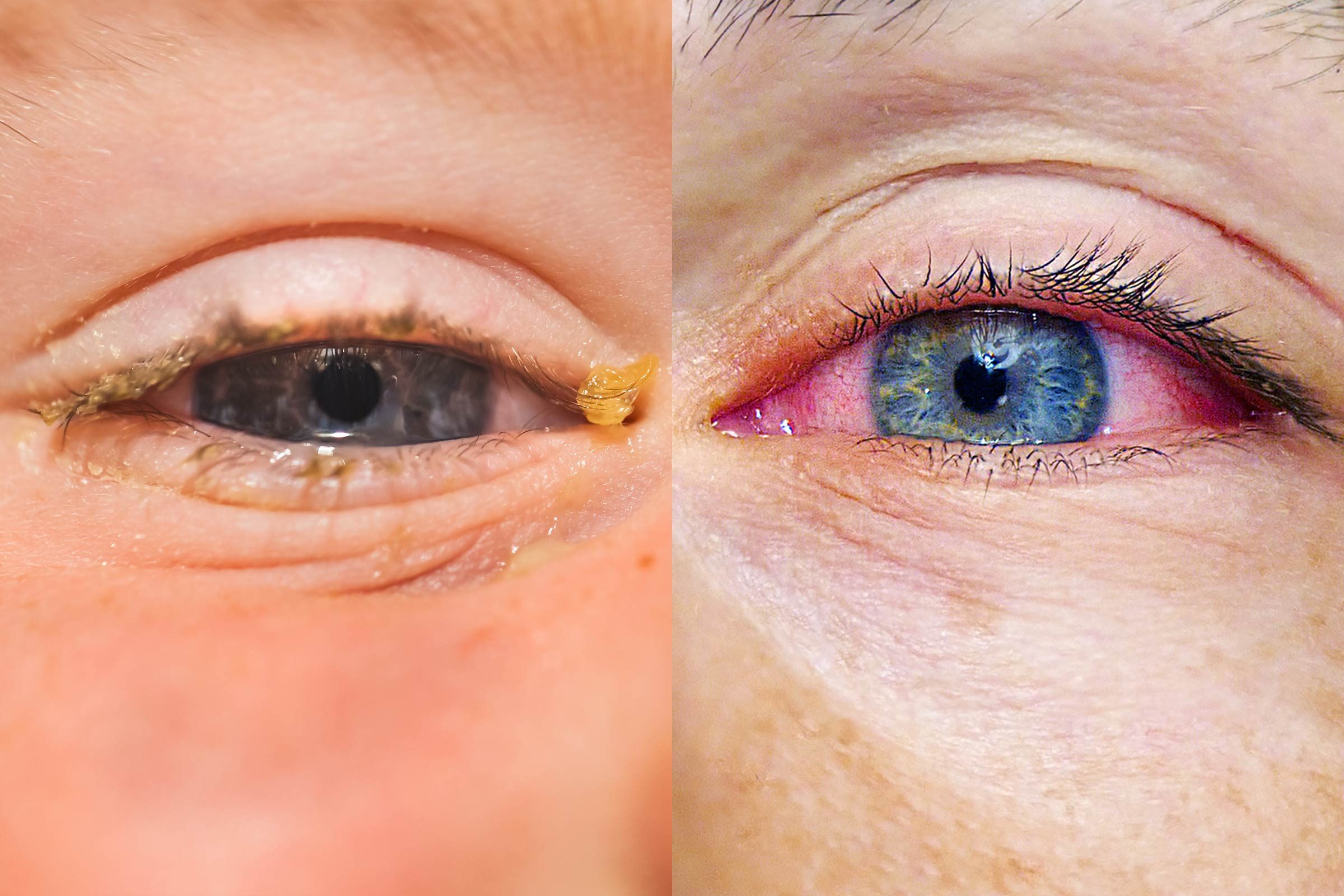 Allergies or Pink Eye: Here's How to Tell the Difference | Reader's Digest