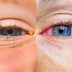 Allergies or Pink Eye: Here's How to Tell the Difference