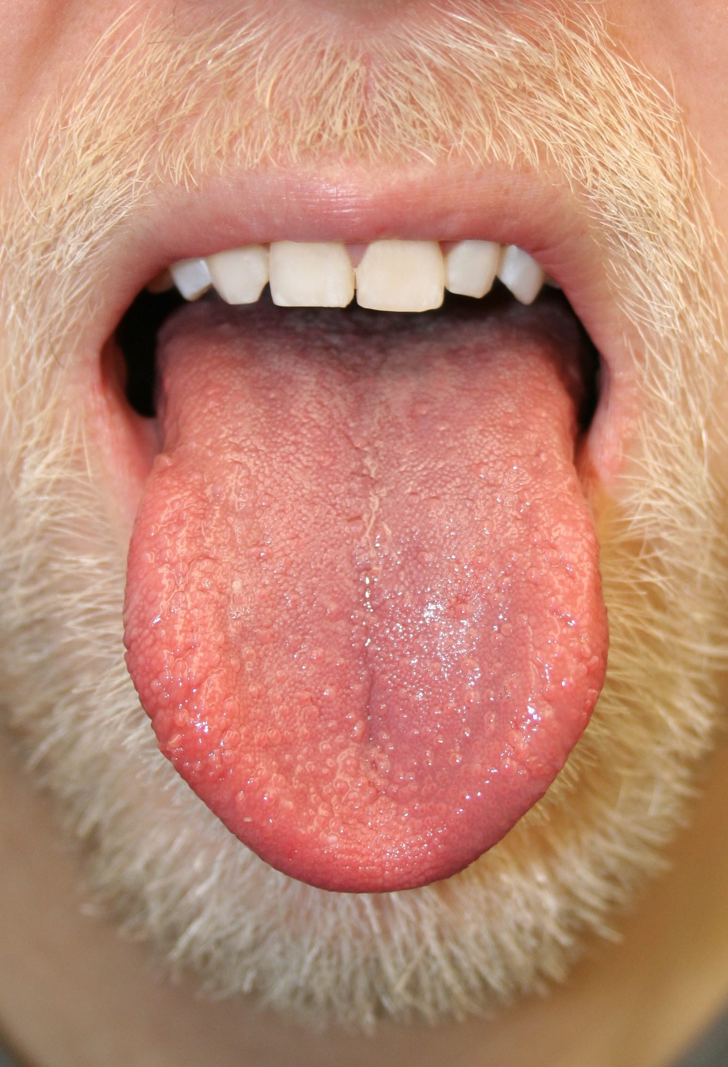 Bumps On The Tongue What It Could Mean Readers Digest