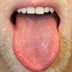 If You Have Bumps on Your Tongue, Here's What They Could Mean