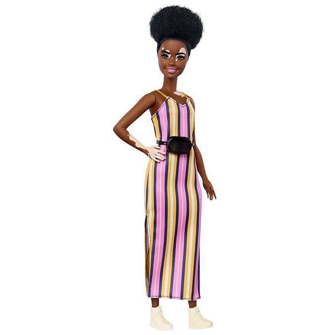 barbie skin condition fashionista vitilago