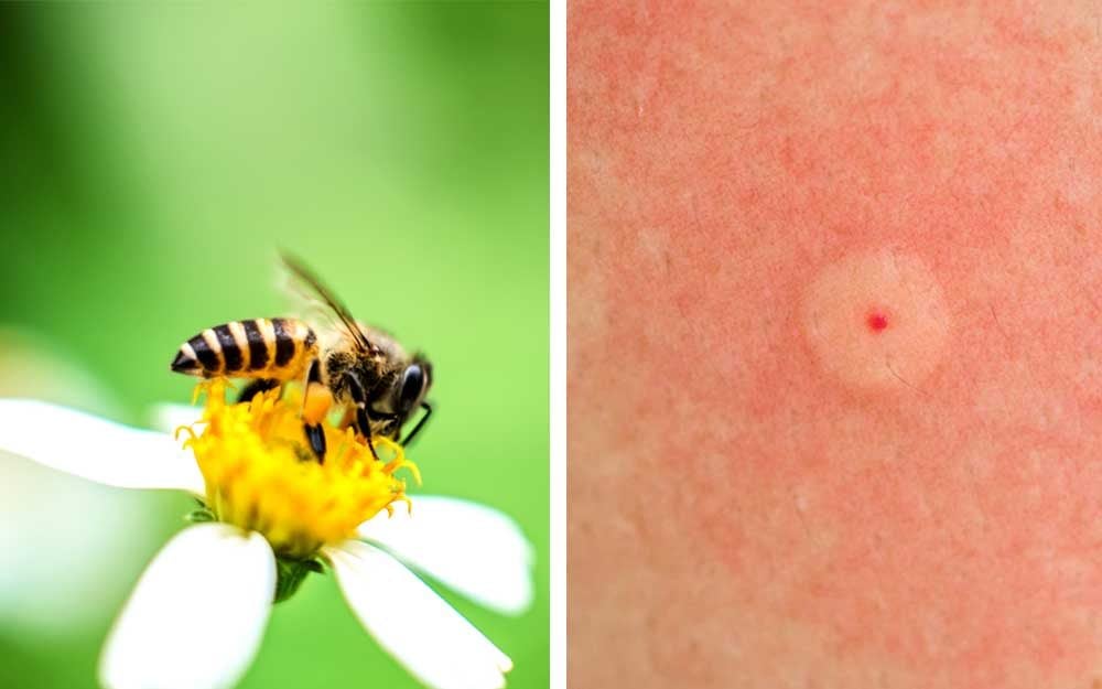 how-to-identify-these-9-common-bug-bites-reader-s-digest