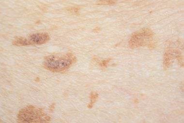 breast cancer symptoms lumps skin marks freckles unusual aren should dark every woman know sign shutterstock